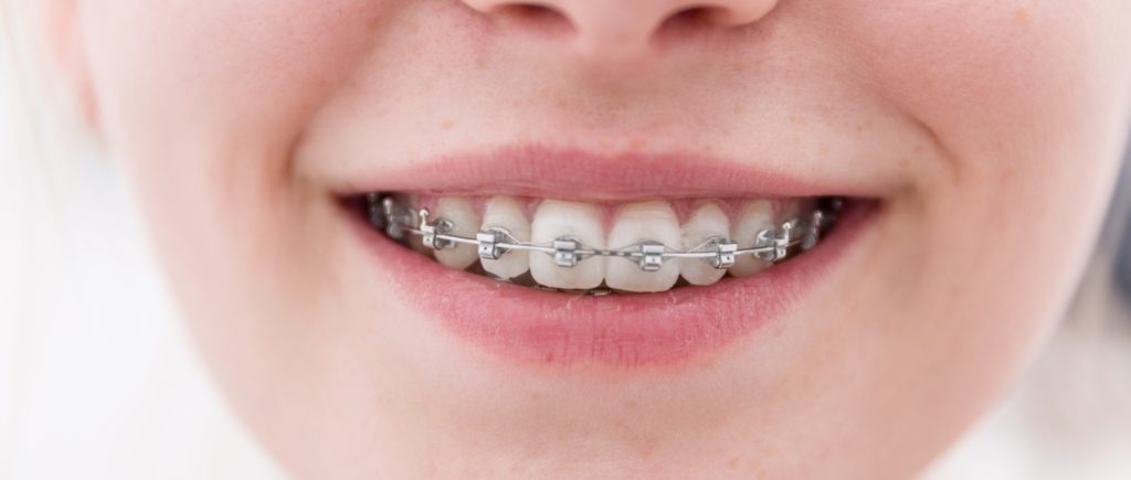 $167/Month Full Orthodontic Case! (Total $3,999) | Pompano Beach, FL | Dental Wellness Team