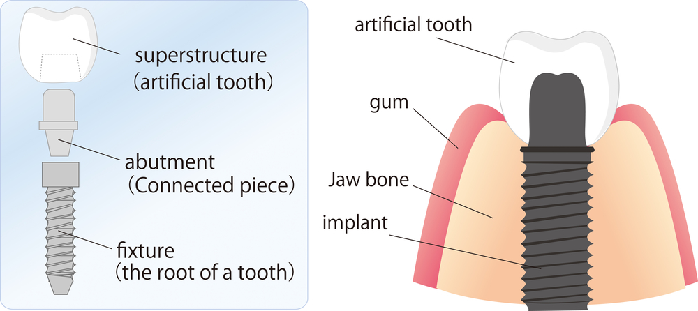 Dental Implants are used with healthy gums, giving a reason to treat gum disease early.