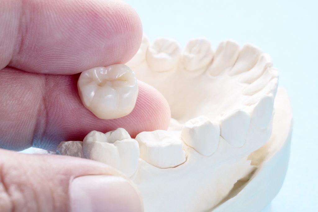 How Much Does a Dental Crown Cost in Coral Springs, FL?