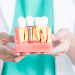 Dental Implants: Myths vs. Facts