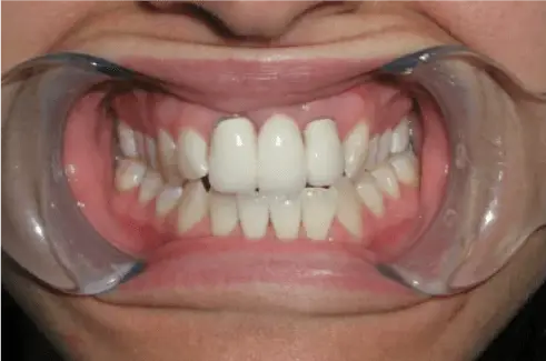 Before Dental Crowns Treatment Image 2