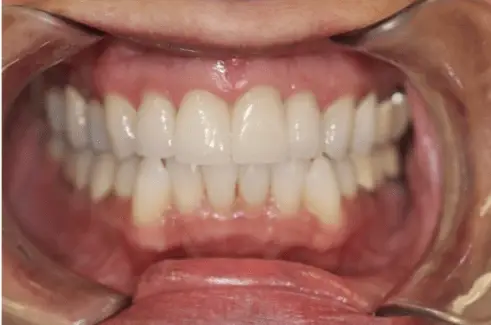 After Dental Crowns Treatment Image 3