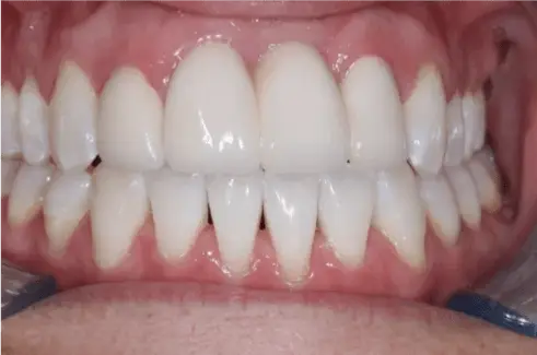 After Dental Crowns Treatment Image 2