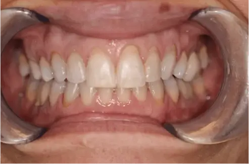 Before Cosmetic Dentistry Treatment Image 2