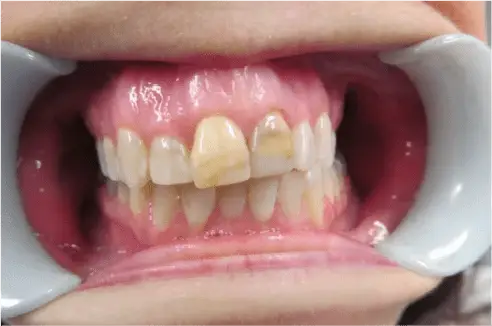 Before Dental Crowns Treatment Image 5