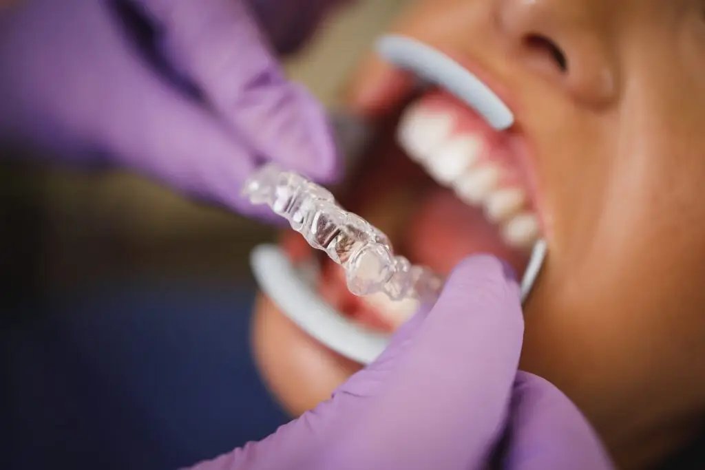 About Clear Aligners
